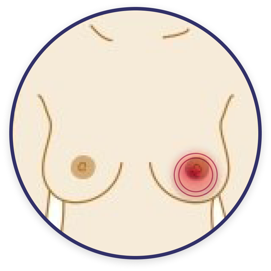Redness or rash around the nipples or areola